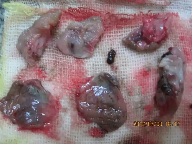 第三十三例环状静曲三期混合痔施先生术前术中术后图片集 - 肛肠外科