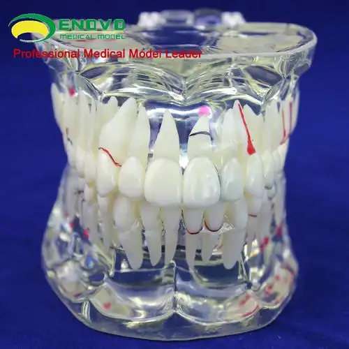 enovo正品 口腔齿科牙科成人口腔病理模型 口腔牙科牙齿模型