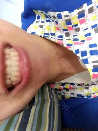 有点地包天,上排中间四颗牙被下牙包住,这样的如何矫正?