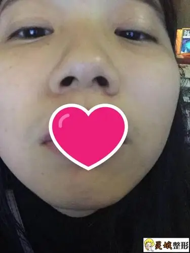 鼻孔缩小手术对比图来喽看如何让鼻子变得更加漂亮