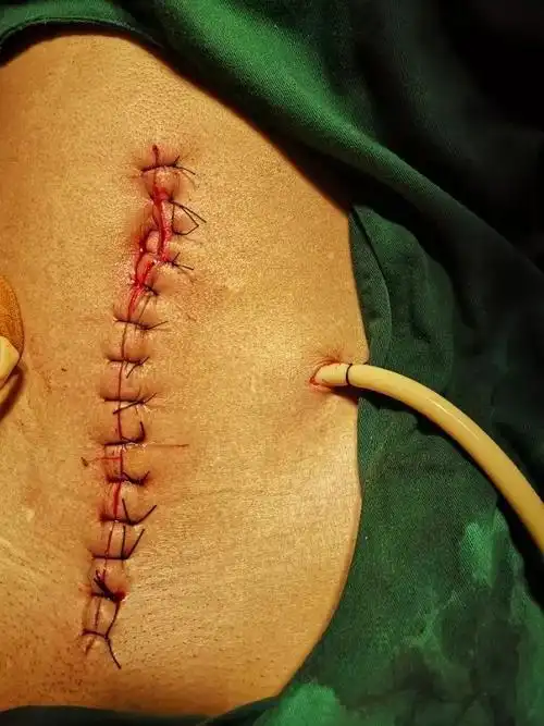 腹腔镜直肠癌手术已经被国家卫健委列入诊疗规范推荐手术方式,在病人