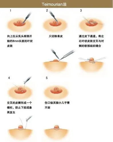 乳头内陷与乳房下垂