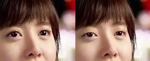 双眼皮和单眼皮的区别