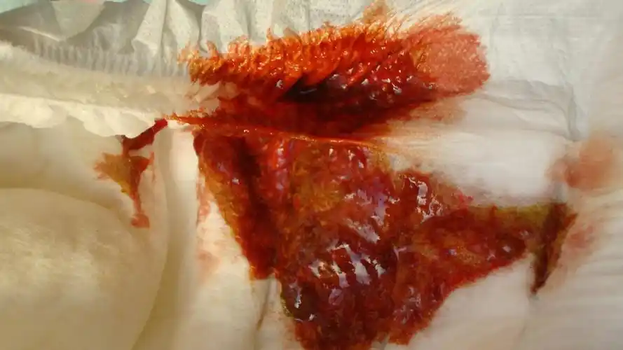 主要症状等):孩子两个月,每天大便5-6次,大便呈红褐色,并且有臭味