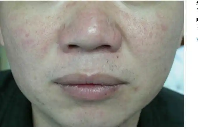 皮肤角质层被面膜严重破坏了还能自己恢复吗?不要介绍产品.