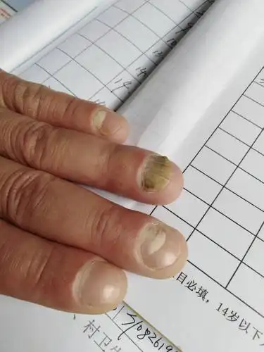 发一组手癣甲癣图片,供大家欣赏 - 皮肤及性传播疾病讨论版 - 爱爱医