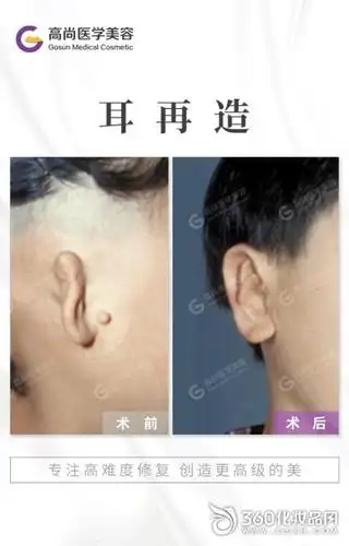 耳朵无耳廓会影响听力吗余文林解答