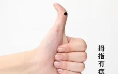 手指上有痣图解:手指上有痣代表什么意思,手指上有痣的人代表什么