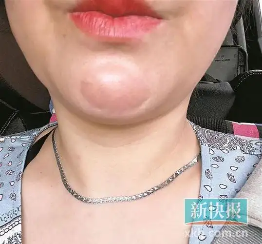 【新快315】女子花4万多元做医美  下巴突起腿不对称