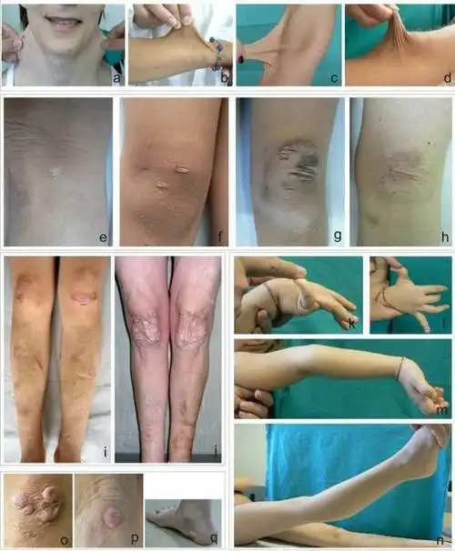 行医笔记一组全身皮肤松弛的疾病