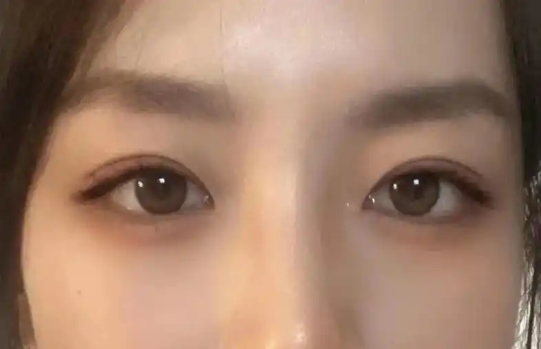 5双眼皮 40天啦 .全切开扇6.5双眼皮 40 - 抖音