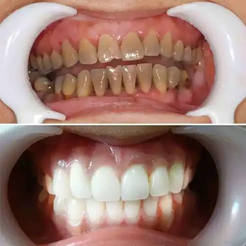 云南本草洗牙粉牙齿美白神器黄牙去烟渍牙渍结石牙斑净除口臭洁牙