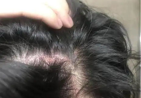 头皮毛囊炎长痘痘怎么办?