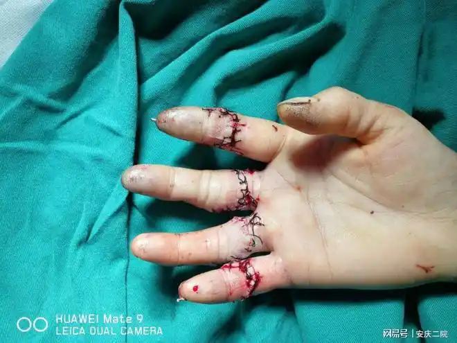 市二院显微外科——断指重生记