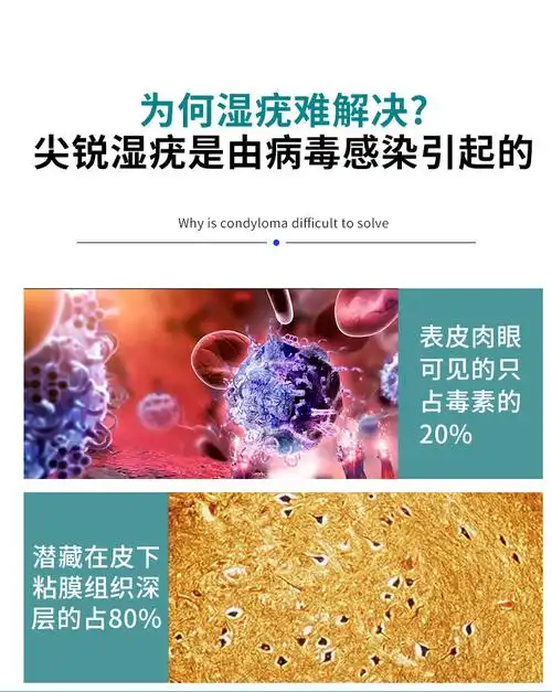 医用清疣凝露尖锐湿疣丝状疣检测hpv病毒男女性私处肛内外阴hpv检测