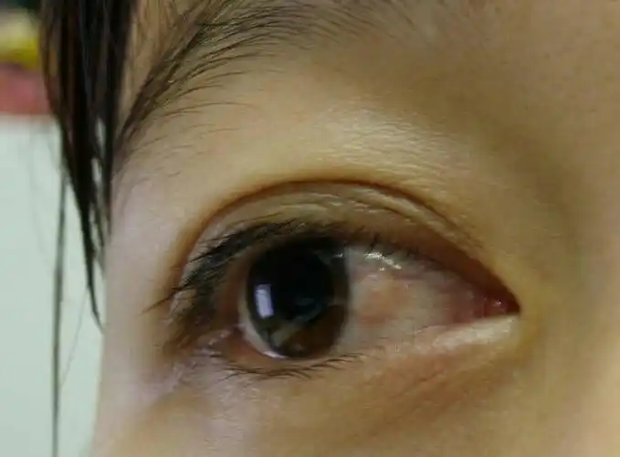 我奶奶今年60 眼睛里长胬肉了如图,刚长一两天,之前眼睛一直不舒服