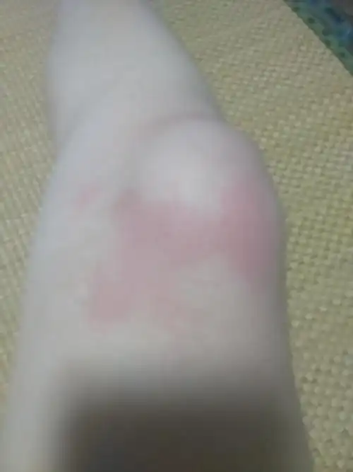 下午去游泳出来后发现腿部皮肤发红摸上去有刺痛感