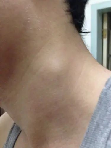 脖子左侧有个包,不疼不痒,用手捏是小肉馏,请问这是什么,怎么办