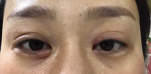 感冒发烧打吊瓶后眼睛肿了局部像水泡状是什么原因应该怎么办?