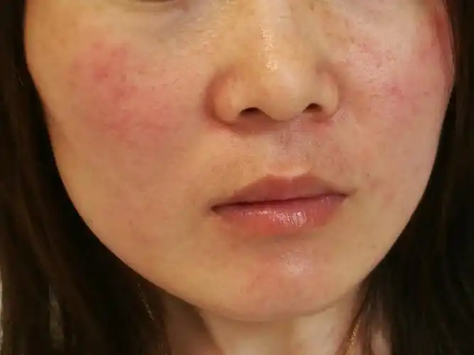 潮红(潮红潮热是绝经期妇女的正常临床表现)