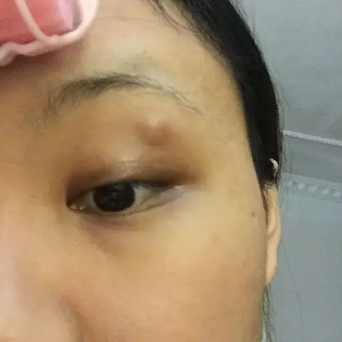 眼皮上方长了一个疙瘩 不痛不痒 两个礼拜左右了 4-5mm 请问这个要去