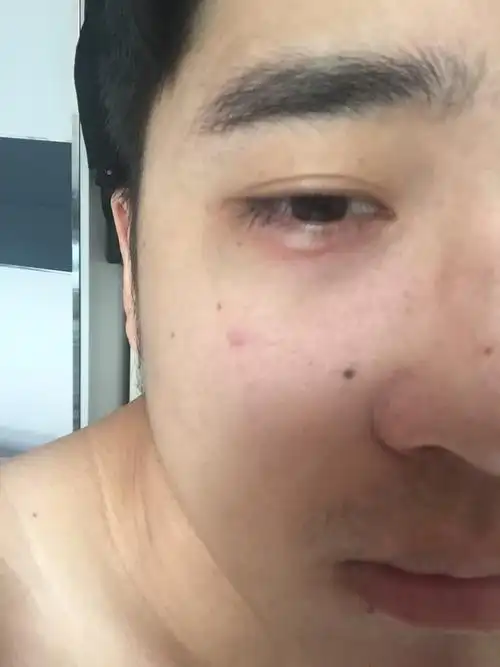 下眼皮长了像蚊子叮咬的疙瘩刚才芦荟胶这会儿感觉烫烫的是什么