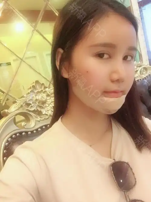 自体脂肪填充全脸膨体隆下巴第三天