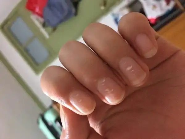 女19岁 指甲盖上好多白点怎么回事?
