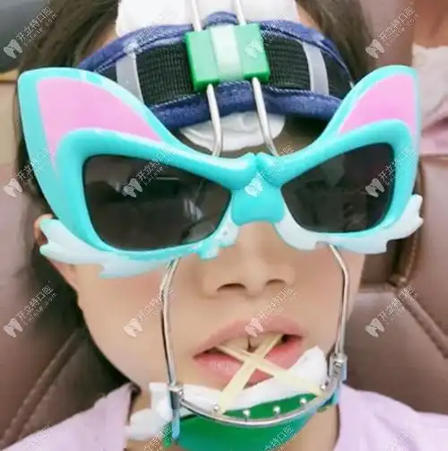 5岁孩子戴儿童反颌矫正牵引器面弓矫治地包天的疗效反馈