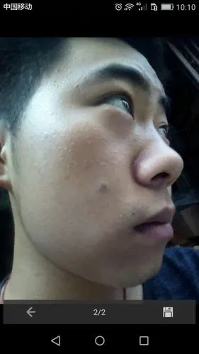 我右脸上有一颗凸起的大痣,去年我用药水点了几次,效果挺好,痣从黑成