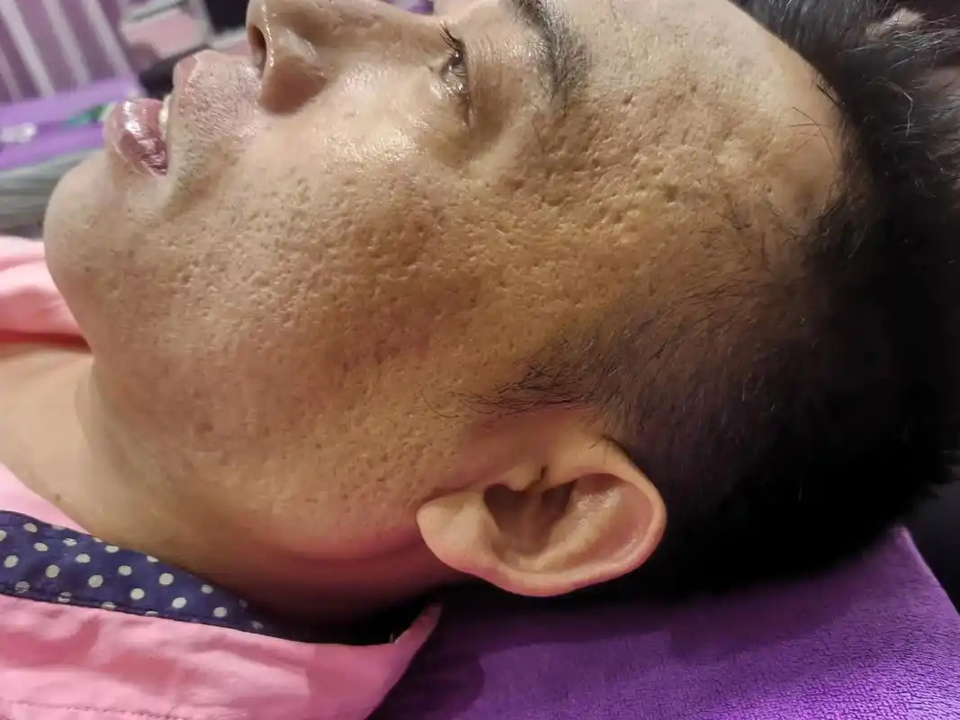 痘坑,麻子脸,操作二次效果!慢慢变好,是对自己的最大认可#耽 - 抖音