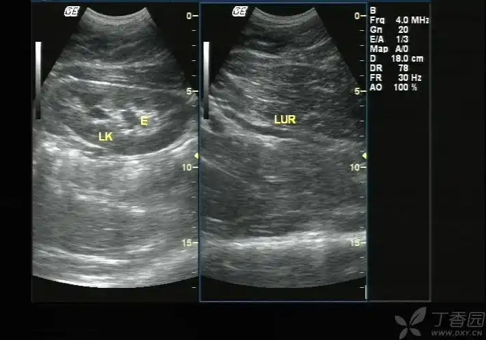 图一:左侧输尿管上段扩张伴左肾轻度积水.