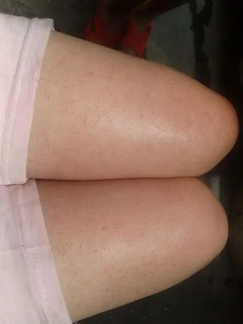 毛囊地方就会出现红肿的现象,这样过度的抠,挤,抓,绕鸡皮肤的部位,不