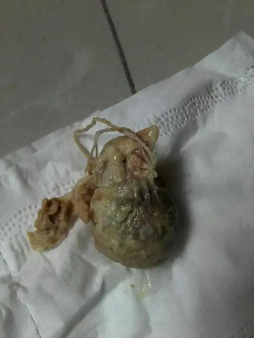 宫颈糜烂三度到底用不用做手术,好迷茫,有没有没有做手术的姐们们