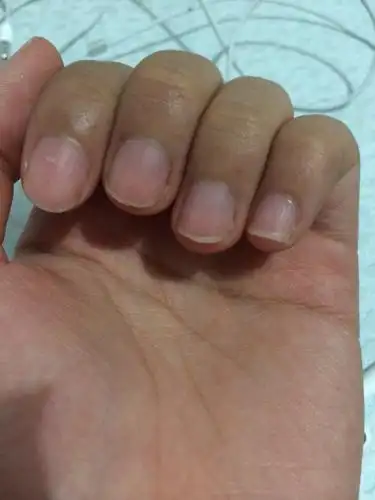 指甲有淡紫色出现还有少量竖条纹是怎么回事