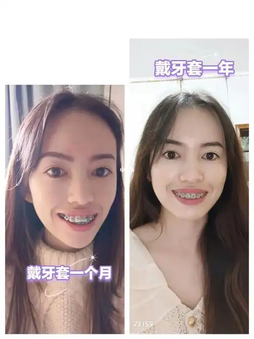 戴牙套一年正面照,果然笑起来都自信了#牙齿矫正  #牙套  #戴牙套