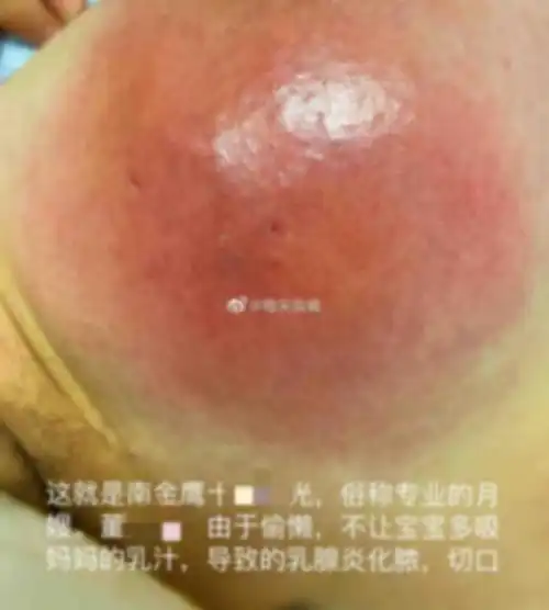 盐城 南金鹰十*阳光月嫂中心,把宝妈弄成乳腺炎住院三次,切口化脓!