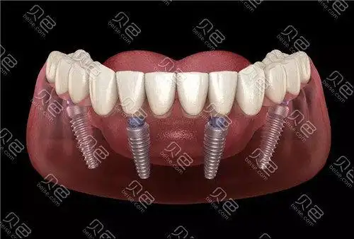 半口种植牙动画图