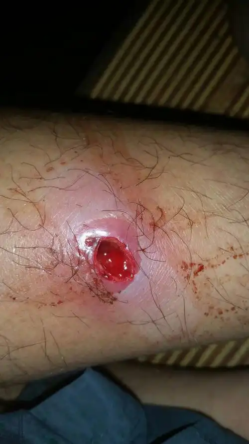 前几天腿上起了个疙瘩,就感觉很痛 走路也痛!