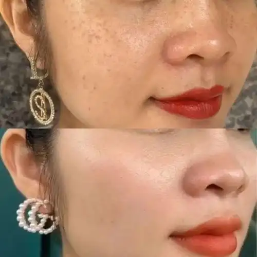 93使用三个月肌肤前后对比:我的症状是怀孕引起内分泌失调导致的