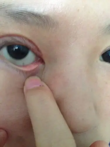 下眼睑里面好像溃疡一样,左右眼都有,一样的位置.