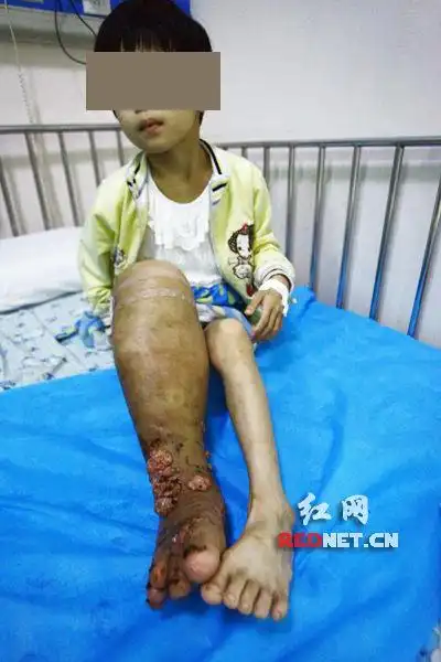 祁东8岁象皮腿女孩渴望上学期待爱心人士救助