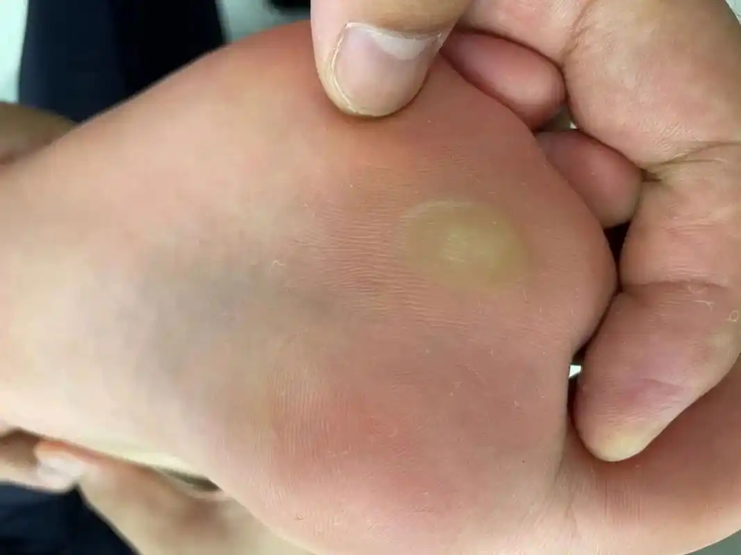 这种情况属于胼胝,俗称脚垫,趾垫,茧子,是由于足部长期受到压迫和