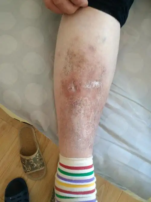 五年老烂腿(皮肌炎破溃)愈合了! - 好大夫在线