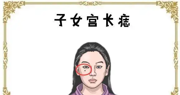 女人5颗"妨夫"痣,婚后拖丈夫后腿,对健康不利!