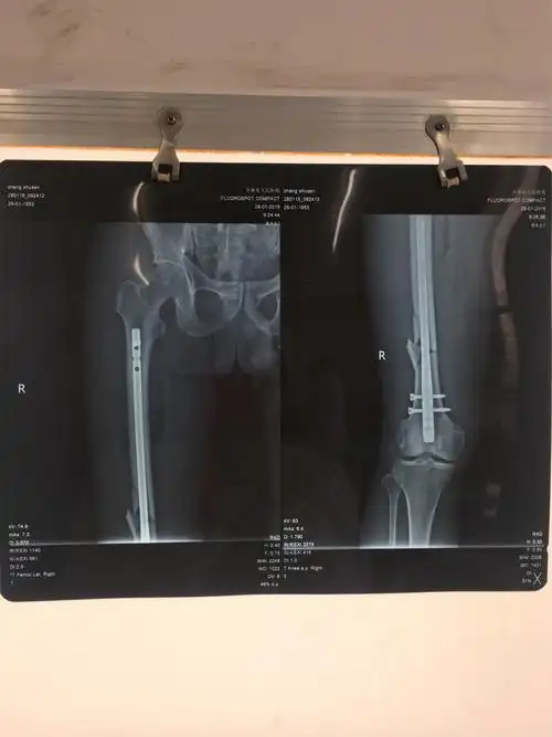 骨科顺利完成我院首例倒打钉内固定术