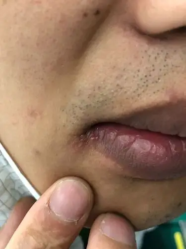 嘴巴上长疱疱,叫做单纯疱疹