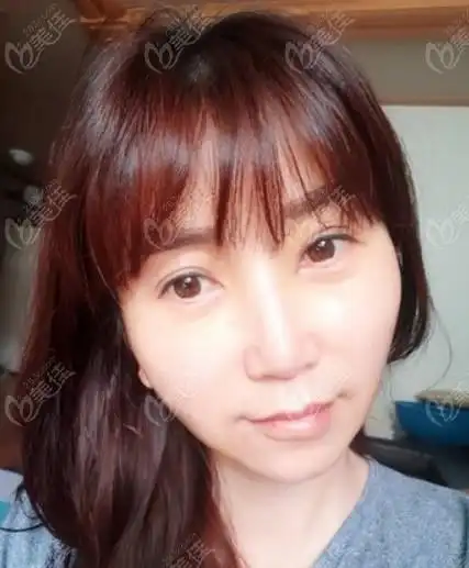 全脸脂肪填充第七天恢复图