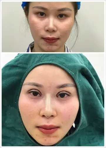 全切双眼皮术后即刻 漂亮了好多_圈子-新氧美容整形