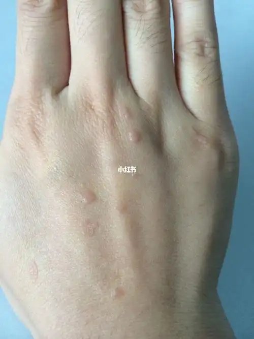 如何快速去掉扁平疣!这个这个方法克星!